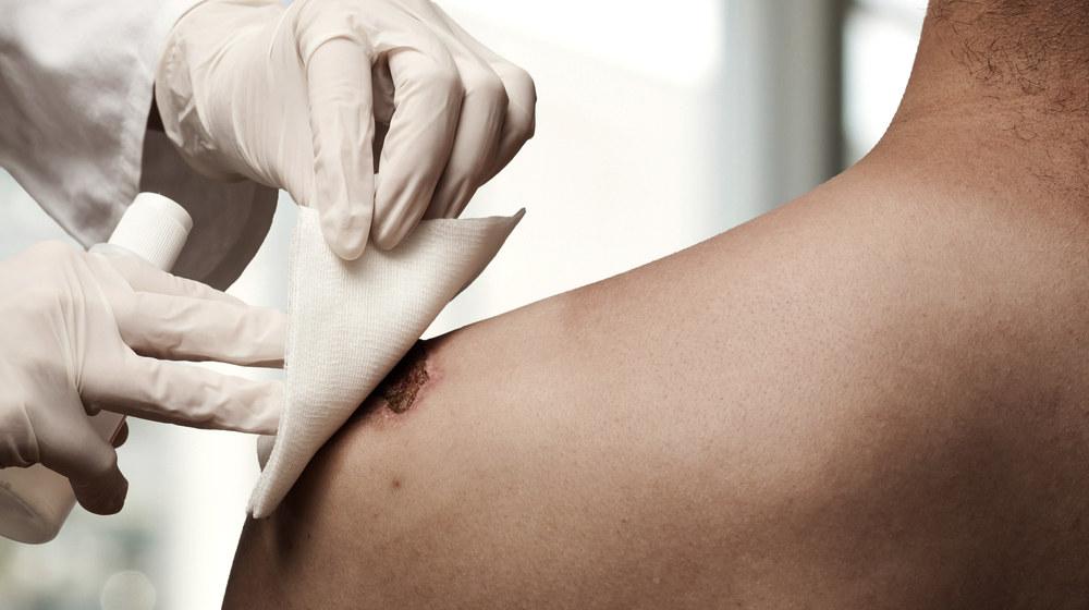 PRP Injection For Wound Healing
