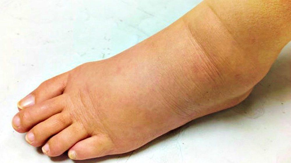 What Causes Lymphedema? | Lymphedema Causes And Other FAQ