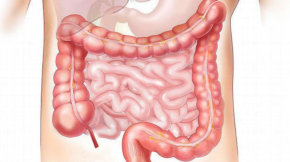 SIBO: Small intestinal bacterial overgrowth