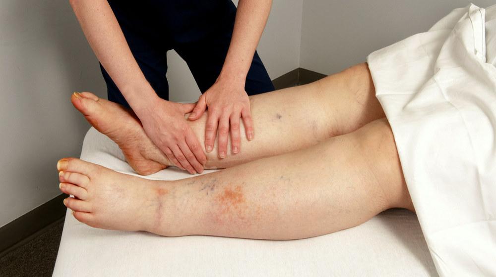 What is Lymphedema and What to do With it?